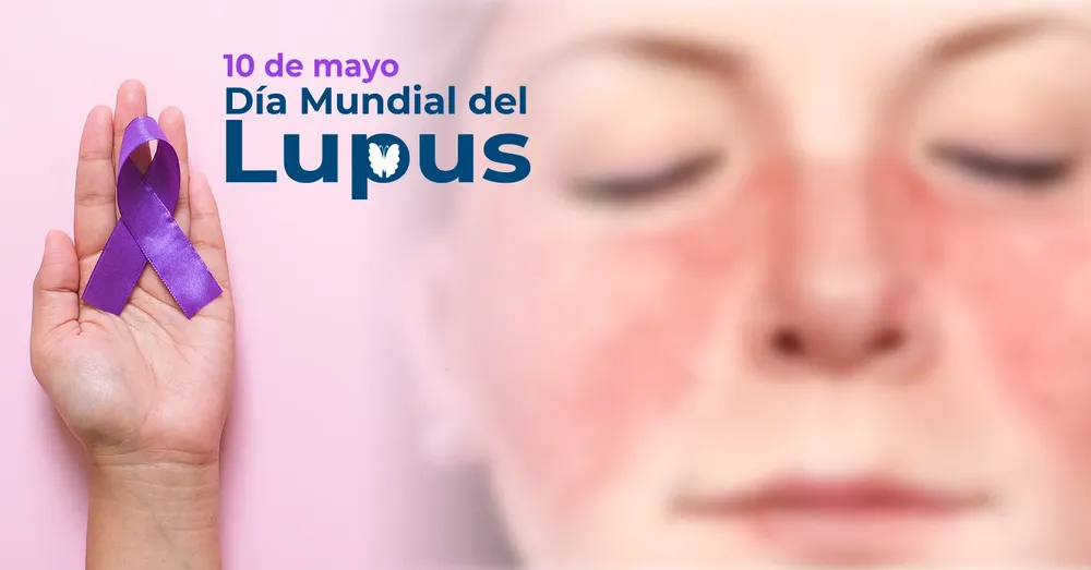 BLOG_PRINCIPAL_10_MAYO_LUPUS